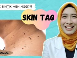 Tips Menghilangkan Skin Tag Dirumah | by dr. Monita
