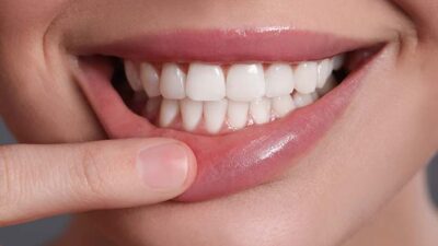 Tips Praktis Memutihkan Gigi di Rumah